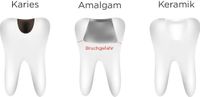 Amalgam oder Composit-Kunststofffüllung-Ihr Zahnarzt Schmücker in Ottobeuren berät Sie gerne