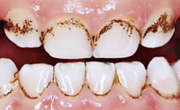 Blach stain-Melanodontie-schwarze Zahnränder bei Kindern