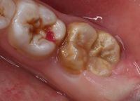 Kreidezähne/MIH, ein problem für Kinderzähne-Wir helfen Ihnen bei ihrem Zahnarzt Schmücker in Ottobeuren