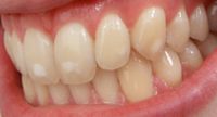 Was ist eine Zahnfluorose-Zahnarzt Schmücker