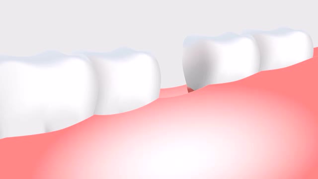 Implantate sind quasi ein Zahnwurzel-Ersatz und damit eine wundervolle Ergänzung für die zeitgemäße Therapie-Beratungstermin bei ihrem Zahnarzt Hans Schmücker, Telefon 08332 8323