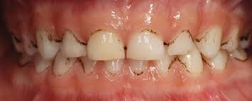 black stain-Hilfe bei schwarzen Zähnen ihrer Kinder-Zahnarzt Schmücker in Ottobeuren